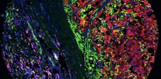 Una estrategia experimental reduce la met&aacute;stasis del melanoma y mejora la inmunoterapia