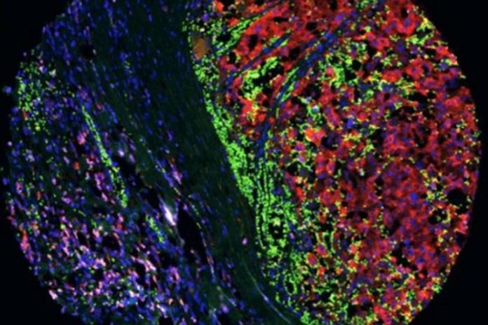 Una estrategia experimental reduce la metástasis del melanoma y mejora la inmunoterapia Una estrategia experimental reduce la metástasis del melanoma y mejora la inmunoterapia