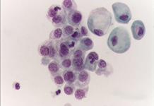 Presentan terapia que cambia el pronóstico del cáncer de vejiga