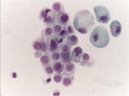 Presentan terapia que cambia el pronóstico del cáncer de vejiga Presentan terapia que cambia el pronóstico del cáncer de vejiga