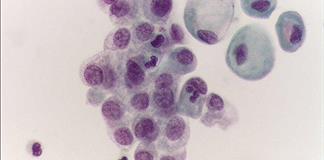 Presentan terapia que cambia el pron&oacute;stico del c&aacute;ncer de vejiga