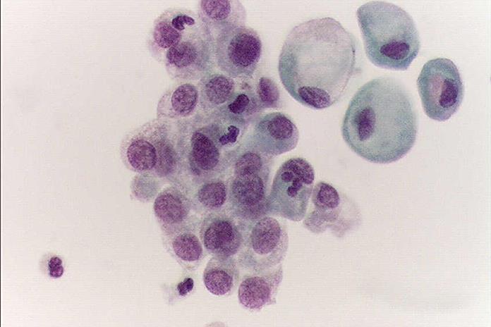 Presentan terapia que cambia el pronóstico del cáncer de vejiga Presentan terapia que cambia el pronóstico del cáncer de vejiga