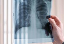 Avances médicos dan esperanza a pacientes con cáncer de pulmón
