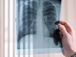 Avances médicos dan esperanza a pacientes con cáncer de pulmón Avances médicos dan esperanza a pacientes con cáncer de pulmón