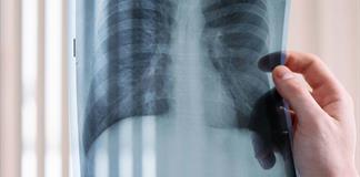 Avances m&eacute;dicos dan esperanza a pacientes con c&aacute;ncer de pulm&oacute;n