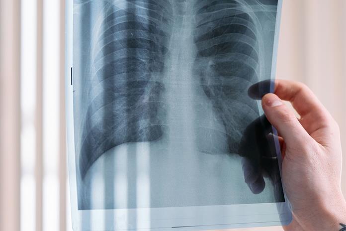 Avances médicos dan esperanza a pacientes con cáncer de pulmón Avances médicos dan esperanza a pacientes con cáncer de pulmón