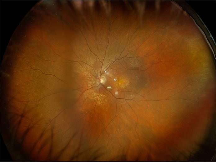 La menopausia también afecta a la visión La menopausia también afecta a la visión