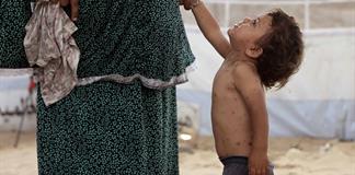 Unicef alerta brote reciente de varicela en Gaza