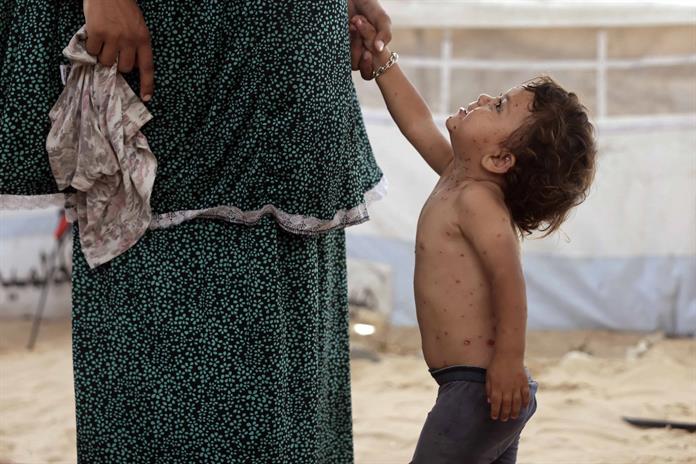 Unicef alerta brote reciente de varicela en Gaza Unicef alerta brote reciente de varicela en Gaza