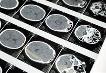 México presenta una tecnología innovadora para el tratamiento de aneurismas cerebrales México presenta una tecnología innovadora para el tratamiento de aneurismas cerebrales