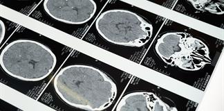M&eacute;xico presenta una tecnolog&iacute;a innovadora para el tratamiento de aneurismas cerebrales