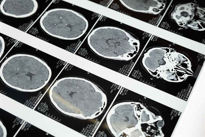 México presenta una tecnología innovadora para el tratamiento de aneurismas cerebrales México presenta una tecnología innovadora para el tratamiento de aneurismas cerebrales