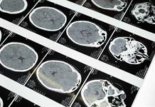 Especialistas alertan: 5 de cada 10 casos de cáncer de cabeza llegan en etapa avanzada