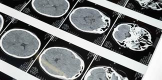 Especialistas alertan: 5 de cada 10 casos de c&aacute;ncer de cabeza llegan en etapa avanzada