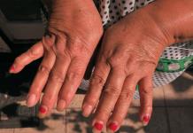 La artritis juvenil afecta a uno de cada 1.000 niños menores de 16 años