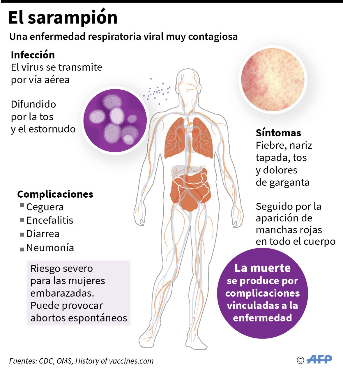 Sarampión