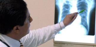 La OMS anuncia un récord de casos diagnosticados de tuberculosis