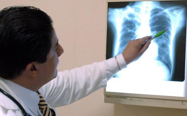 Tuberculosis, otro brote que preocupa a la comunidad médica del país Tuberculosis, otro brote que preocupa a la comunidad médica del país