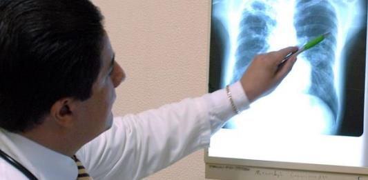 Realizan foro para analizar las secuelas de la hipertensión arterial pulmonar