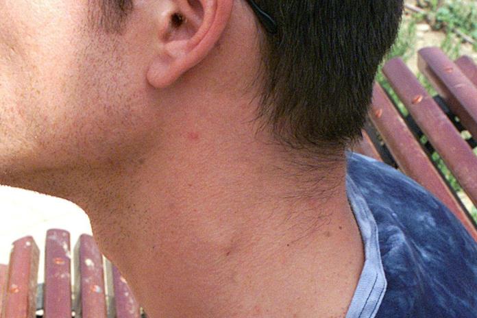 sintomas de cancer de cuello en hombres