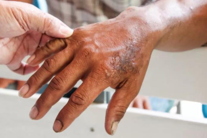 2020 cerró con 38 personas con tratamiento de lepra en Jalisco