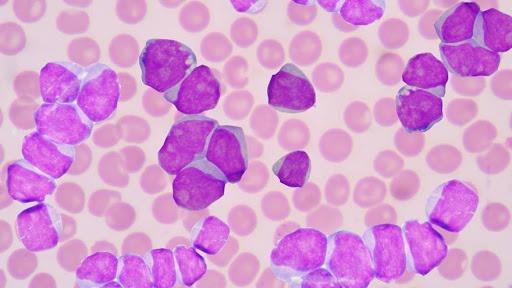 Llaman a detectar a tiempo leucemia en adultos para mejorar pronóstico de vida