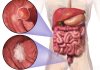 Principales causas del cáncer de colon en la actualidad