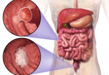 Principales causas del cáncer de colon en la actualidad